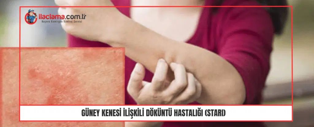 Güney kenesi ilişkili döküntü hastalığı (STARI)