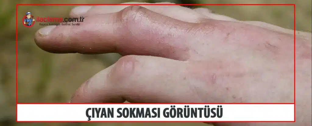 çiyan sokarsa ne olur