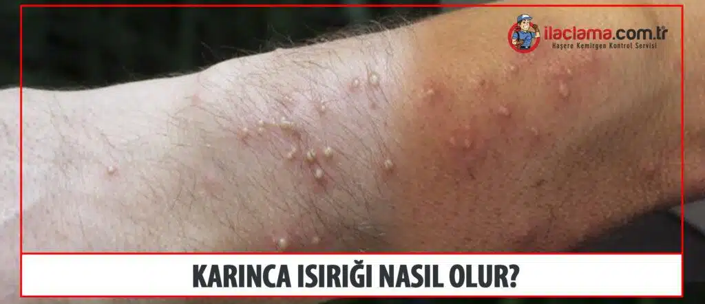 karınca ısırığı nasıl olur 