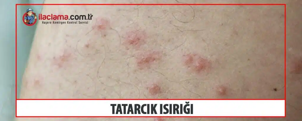 tatarcık ısırığı